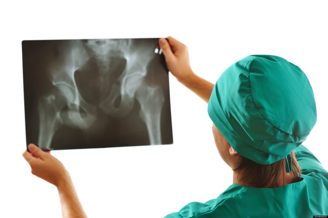 Imagen de rayos X de la articulación de la cadera con artrosis.